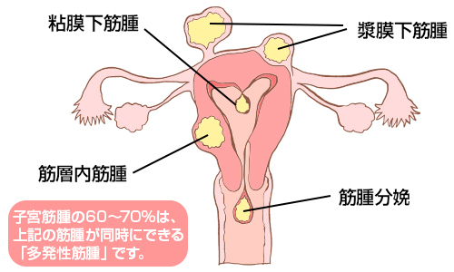子宮筋腫