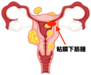 粘膜下筋腫