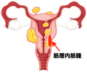 筋層内筋腫