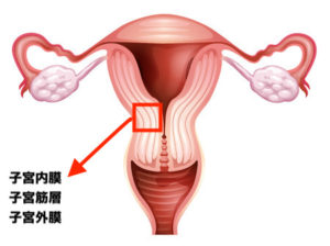 子宮筋腫