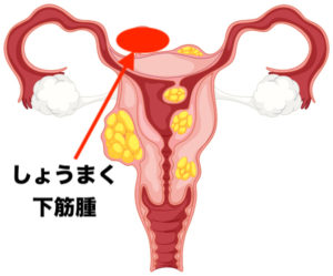 漿膜下筋腫